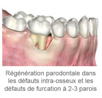 REBONE GRANULES CORTICO-CANCELLOUS UBGEN