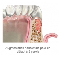 REBONE GRANULES CORTICO-CANCELLOUS UBGEN