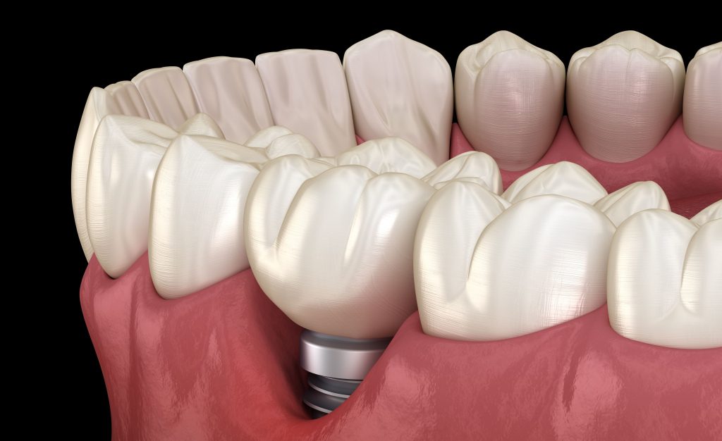 Péri-implantite 2/3 : données épidémiologiques, moyens de