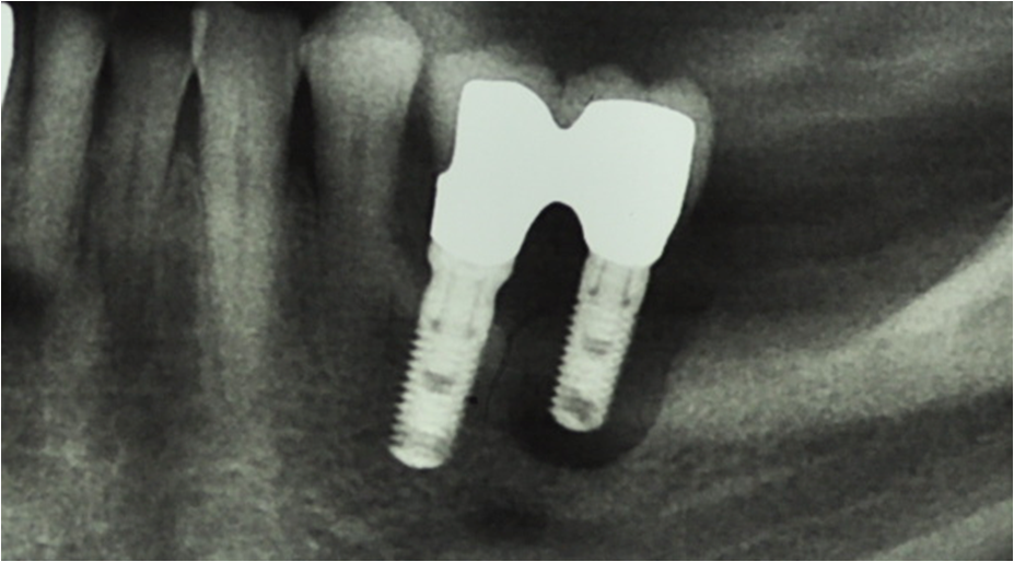 Peri-implantitis and periodontitis. Experimental and clinical studies