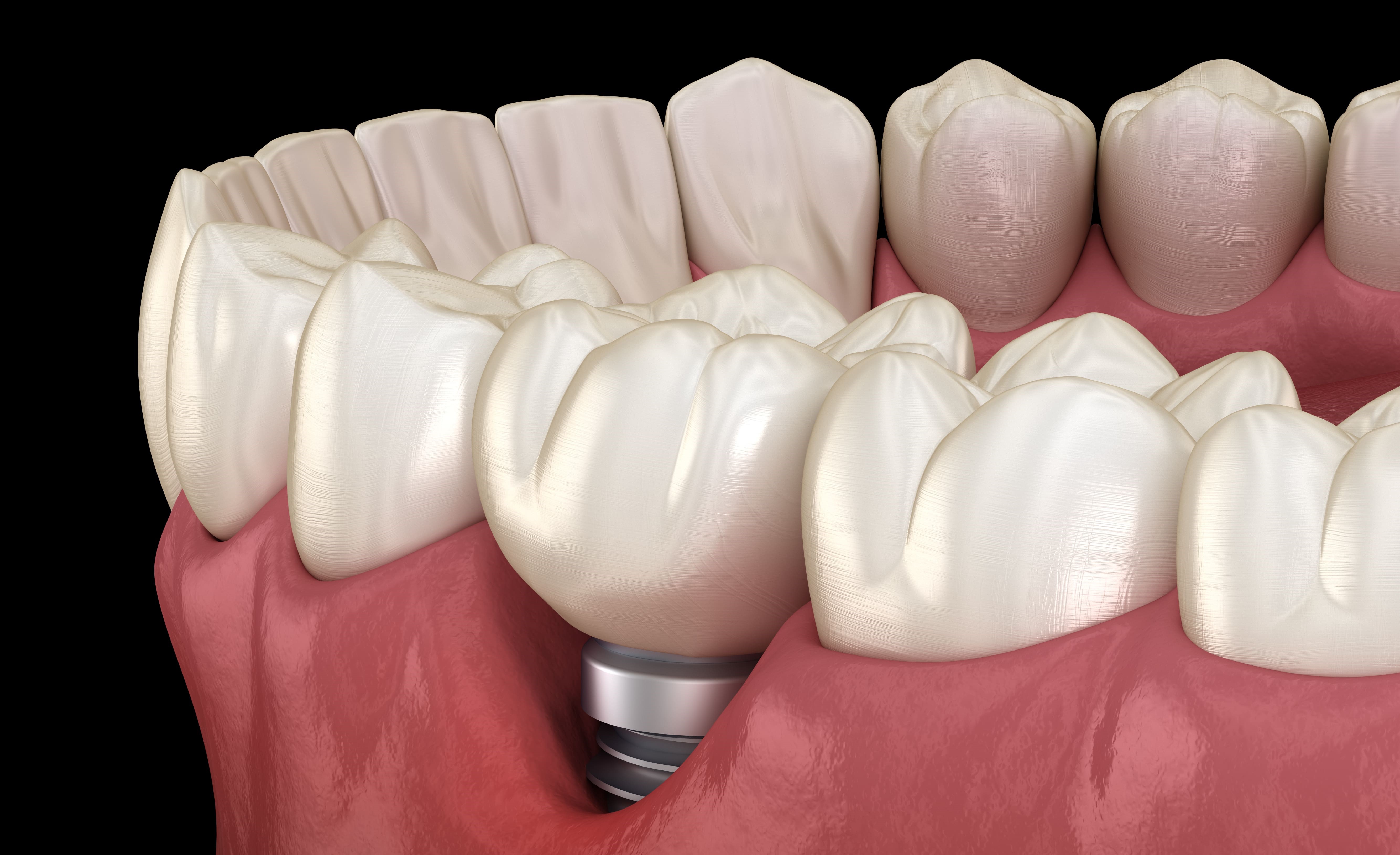 Péri-implantite 2/3 : données épidémiologiques, moyens de diagnostic et facteurs de risques.