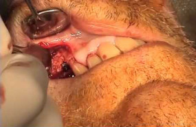 Implant avec greffe vestibulaire