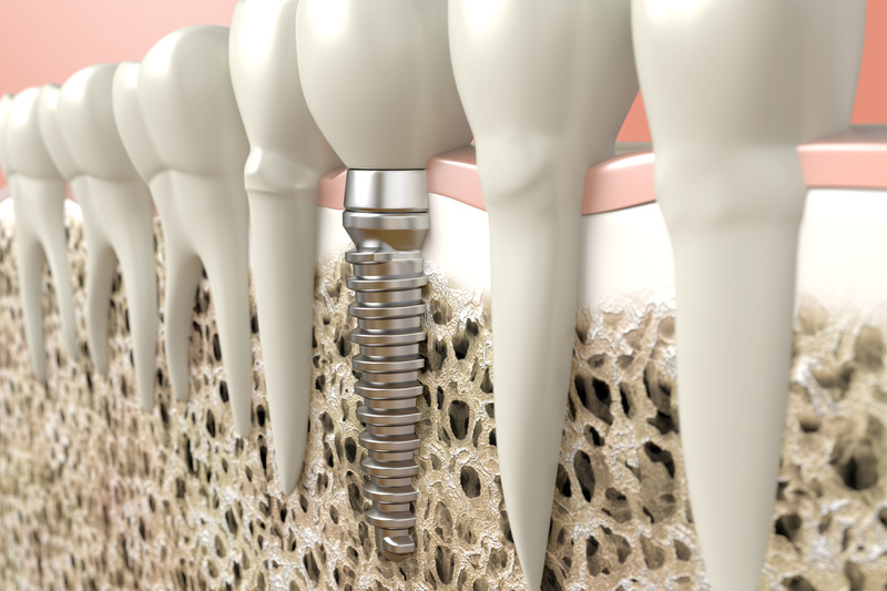 Combien coûte un implant ?