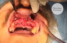 Extractions et implantation différée