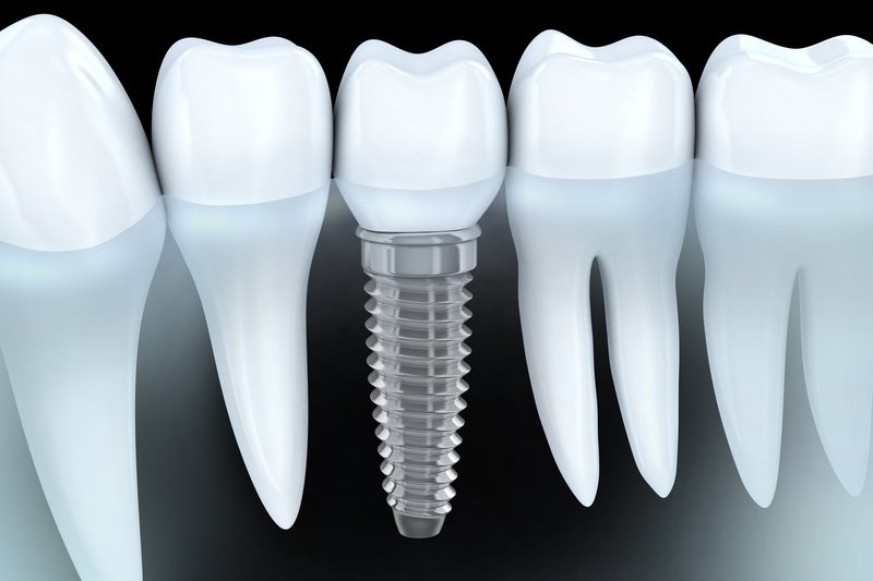 Comment identifier un implant ? Comment identifier un implant ?