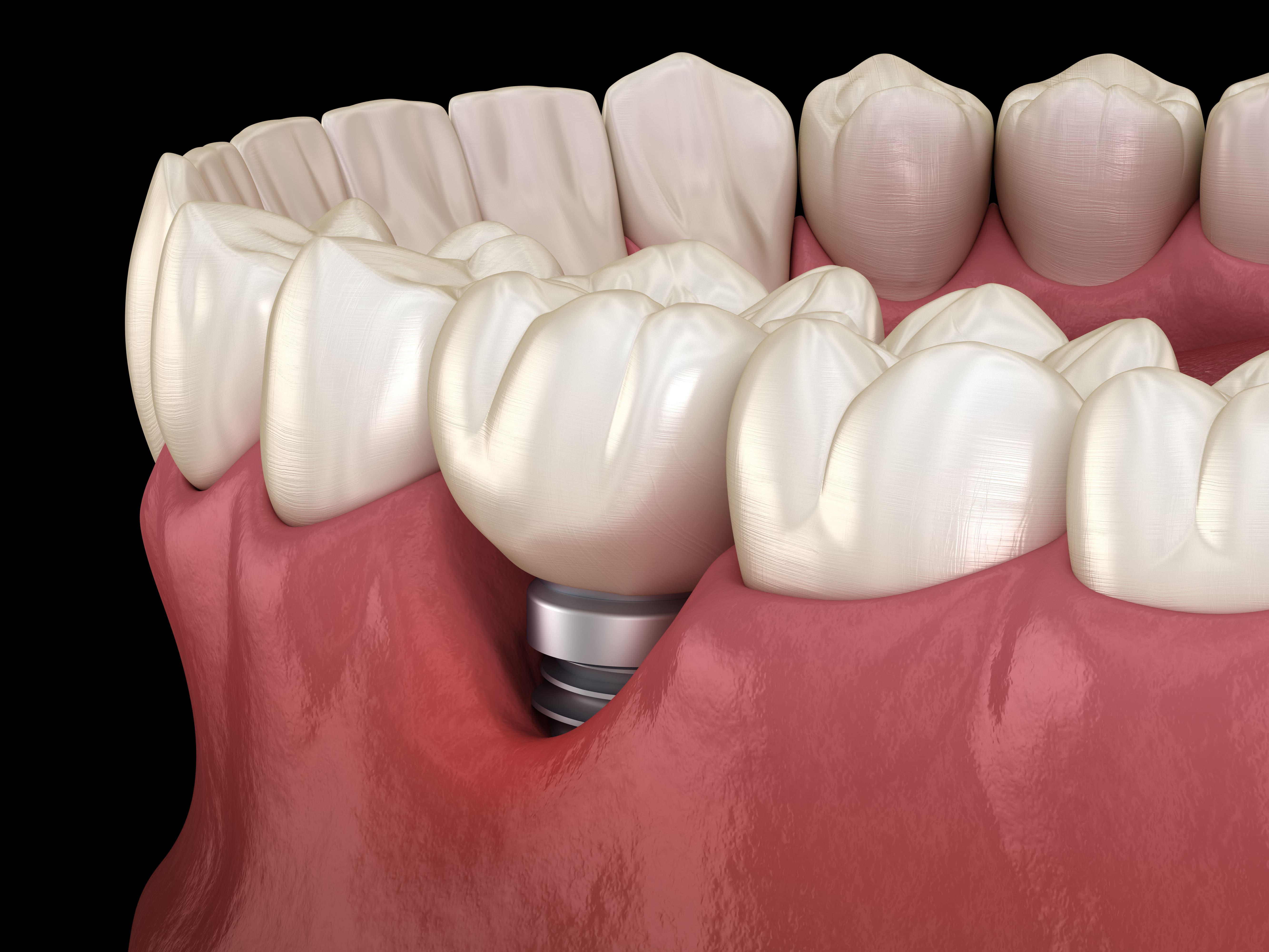 Péri-implantite 1/3 : rappel anatomo-hiostologique et définitions.
