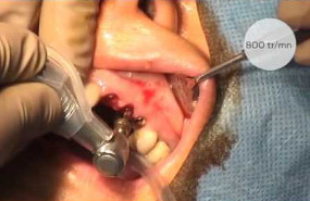 Pose d'implants flapless