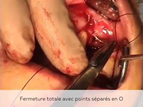 Pose d'implant avec greffe d'apposition Pose d'implant avec greffe d'apposition
