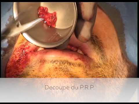 Pose d'implants avec greffe osseuse renforcée aux P.R.F