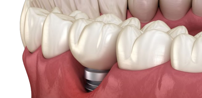 Péri-implantite : comment la prévenir, comment la gérer ?